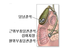 담낭결석 이미지