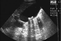 담낭 초음파사진 이미지