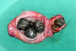 담낭결석 이미지