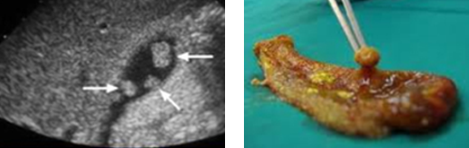 담낭용종 이미지