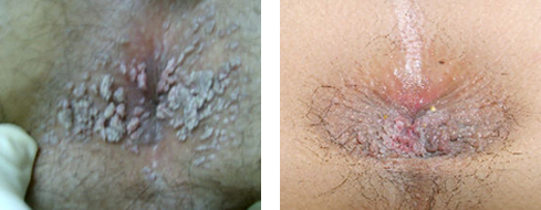 항문콘딜로마 이미지