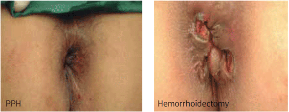 수술직후 비교 이미지