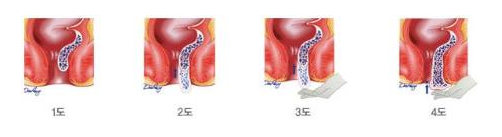 내치핵의 진행정도 이미지