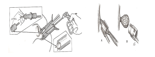 고무밴드 결찰법 이미지