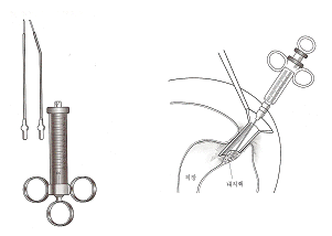 경화요법 이미지