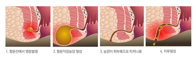 치루 이미지
