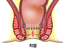 치열 이미지