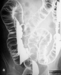 바륨 대장 조영술 이미지
