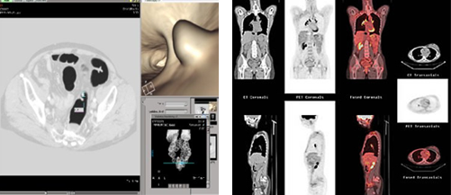 CT 대장조영술에서 발견된 대장암 이미지
