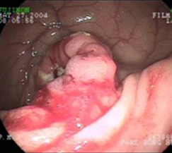 대장내시경검사에서 확인된 대장 이미지