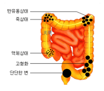변비 원인 이미지