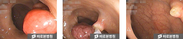 대장용종절제술 과정 이미지