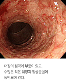 궤양성 대장염 이미지