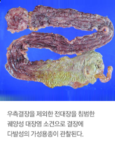 궤양성 대장염 이미지