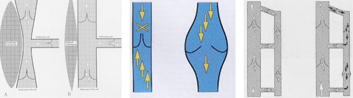 하지정맥류 이미지