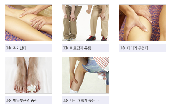 하지정맥류 증상 이미지