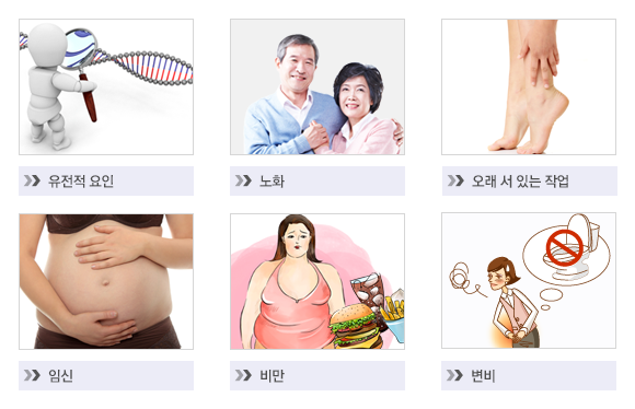 하지정맥류 원인 이미지