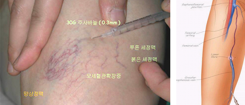 레이저 정맥류 수술 이미지