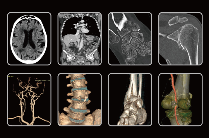 인공관절 수술로봇 사진