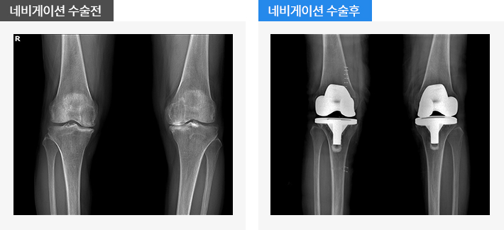네비게이션을 이용한 인공관절 치환술의 수술 전 후 사진