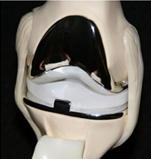 인공관절 보험물의 구성 이미지