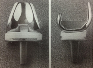 후방 안정 보형물 이미지