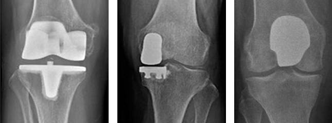 인공관절 이미지