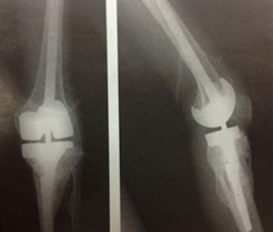 재치환술 보형물 이미지