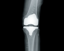인공관절 보험물의 구성 이미지