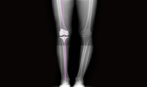 정상 무릎 설명이미지