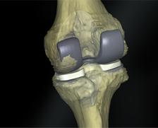 인공관절 보험물의 구성 이미지
