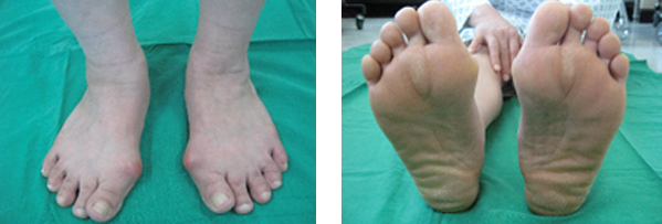 무지외반증  이미지