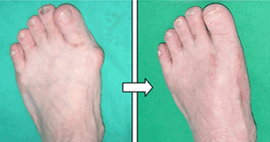 무지외반증  이미지