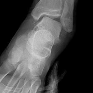 만성 인대 불안정성  이미지