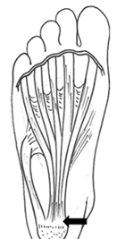 족저근막염  이미지