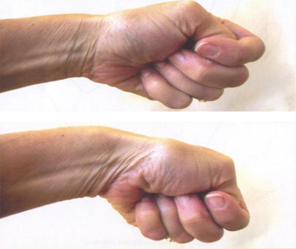 휑켈 스타인 검사  이미지