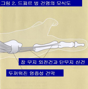 드꾀르 병 건염의 모식도  이미지
