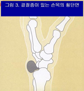 결절종이 있는 손목의 횡단면 이미지