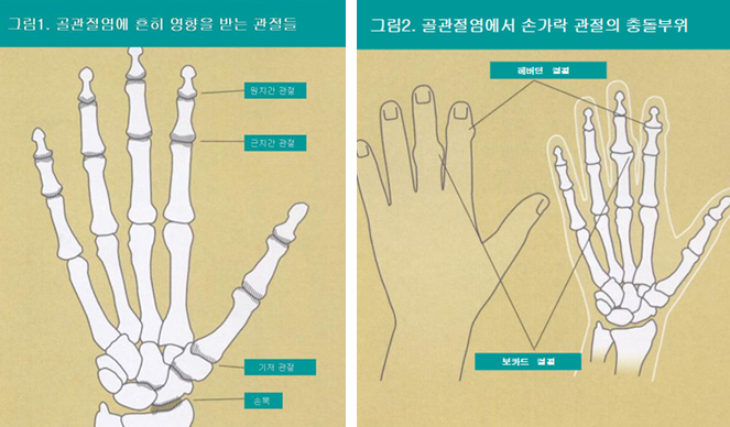 골관절염에 흔히 영향을 받는 관절이미지와 골관절염에서 손가락 관절의 충돌부위 이미지