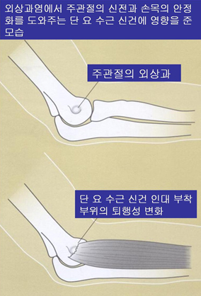 외상과염에서 주관절의 신전과 손목의 안정화를 도와주는 단 요 수근 신건에 영향을 준 모습 이미지