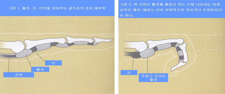 방아쇠수지 이미지