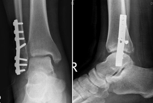 족부 족관절 골절 이미지