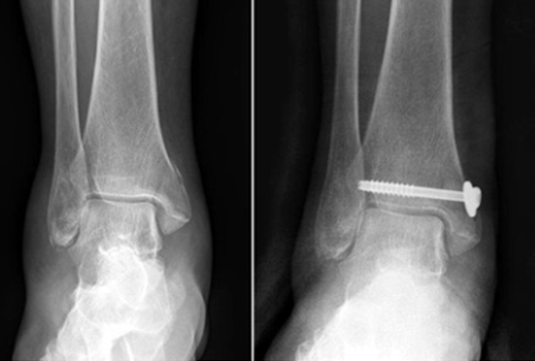 족부 족관절 골절 이미지