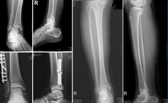 족부 족관절 골절 이미지