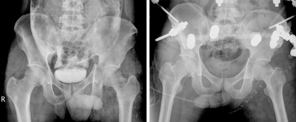 비구 골절과 천골 골절의 외고정술 이미지