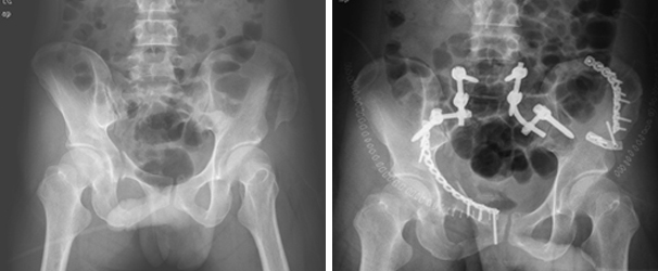 골반환 골절 및 장골 골절의 내고정술 이미지