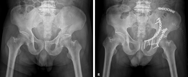 전 후방 비구 골절의 내고정술 이미지