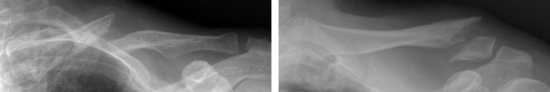 우측 쇄골의 중간(좌), 원위부(우)가 골절되어 어긋나 있습니다.