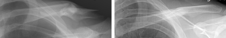 비수술적 치료로 뼈가 잘 붙은 사진