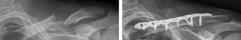  쇄골의 중간부위에 어긋난 골절을 금속판으로 고정한 수술 사진